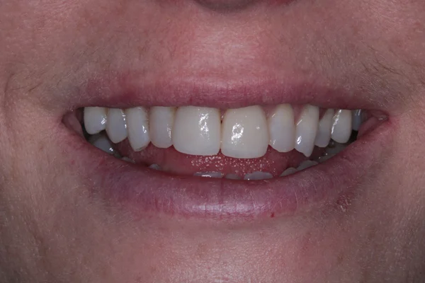 Porcelain-Veneers-After